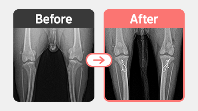 5살 요크셔테리어의 우측 슬개골 탈구 교정 수술 후 방사선 사진. 대퇴고랑성형과 경골조면 이식을 통해 정렬이 개선됨.
