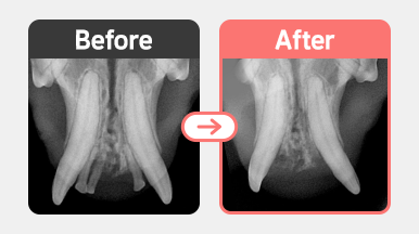 치주염 진행으로 인한 치은 퇴축 및 치아 조직 파괴 확인