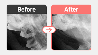 8살 말티즈의 치과 X-ray. PD4 M3 단계 치주염에 해당하며 치조골이 100% 소실되고 치근부 지지가 완전히 사라진 치아 병변.