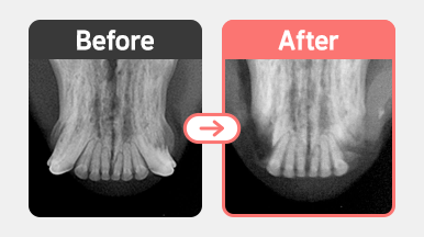 6살 코숏의 치과 X-ray. 치주염과 치아흡수성병변으로 인한 치근 손상 및 치조골 소실이 확인되어 외과적 발치가 시행된 부위.