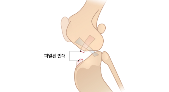 손상된 십자인대
