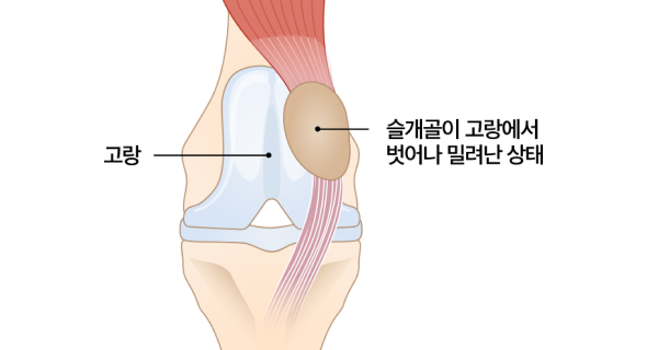 슬개골이 탈구된 상태