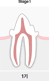 치아흡수성병변 1기