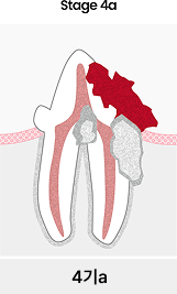 치아흡수성병변 4기a