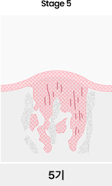 치아흡수성병변 5기