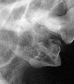 수술케이스 1 before