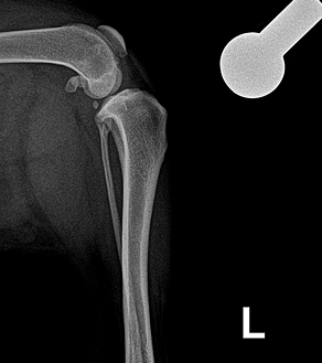 수술케이스 1 before