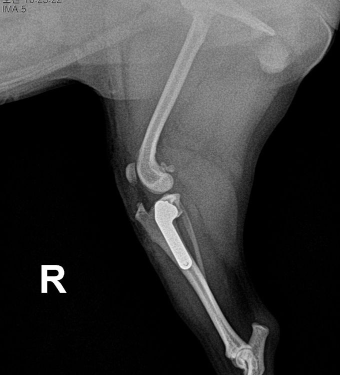 수술케이스 3 after