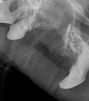 수술케이스 2 after